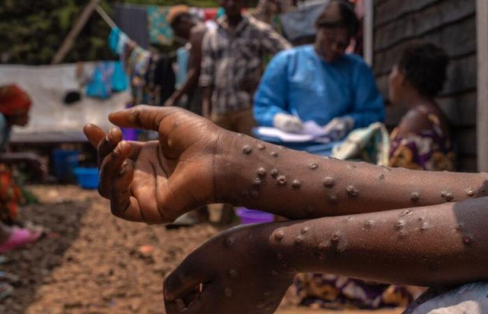 Africa: Mpox: slight slowdown in contamination in Africa