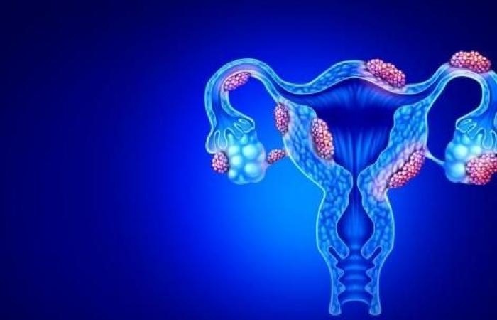 Endometriosis: a discovery could explain the pain and growth of lesions