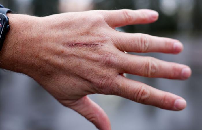 Montreal | Stung by a dirty syringe while trying to pick up his keys