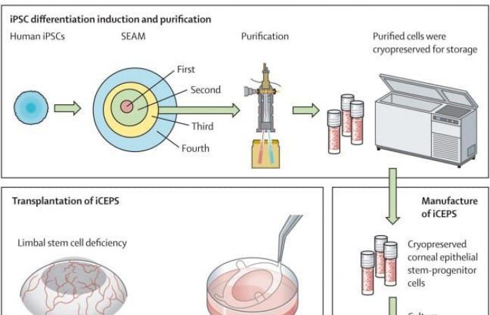 stem cell treatment restores sight in patients with severe eye disorders