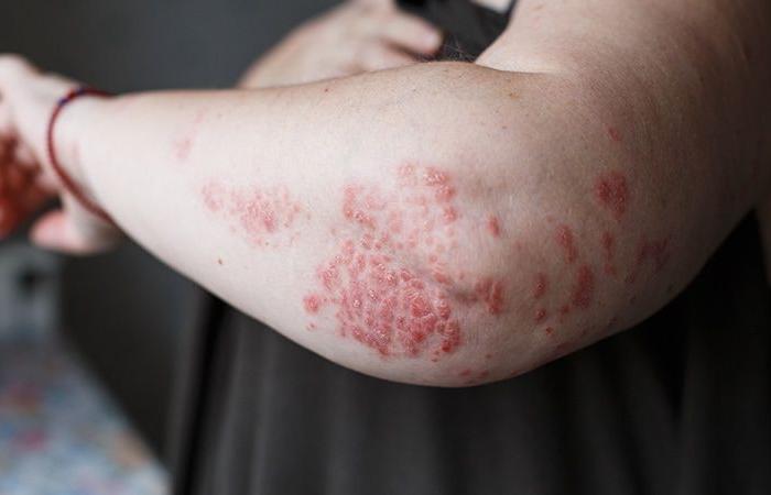 Zasocitinib, another Tyk2 inhibitor to treat oral psoriasis