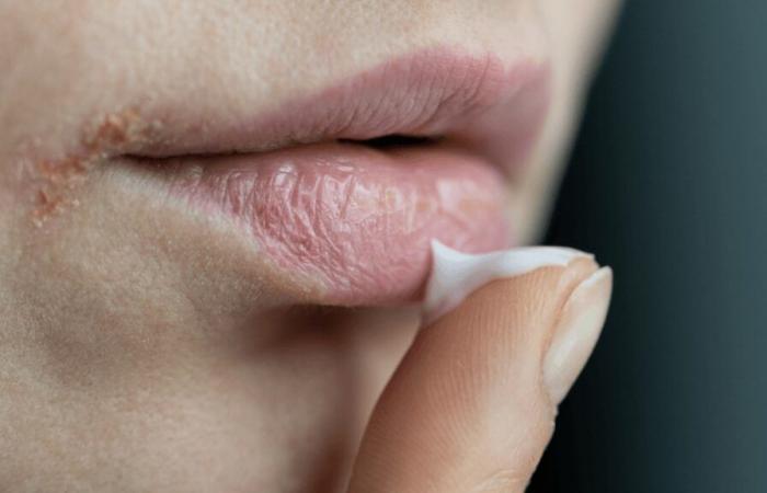 Here’s why you should never use Homeoplasmin as a lip balm