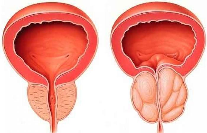 Prostate cancer screening: Launch of the “Blue November” campaign