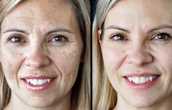 I tested the IPL treatment for rosacea and spots and here is my opinion