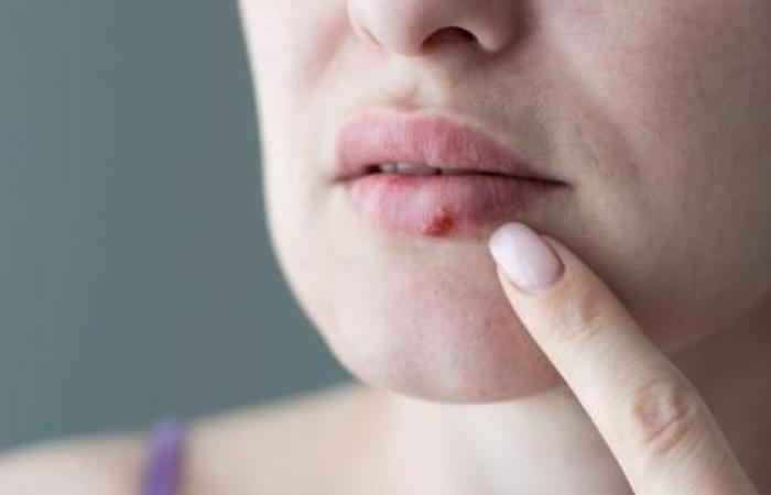 the cold sore virus can find its way to the brain