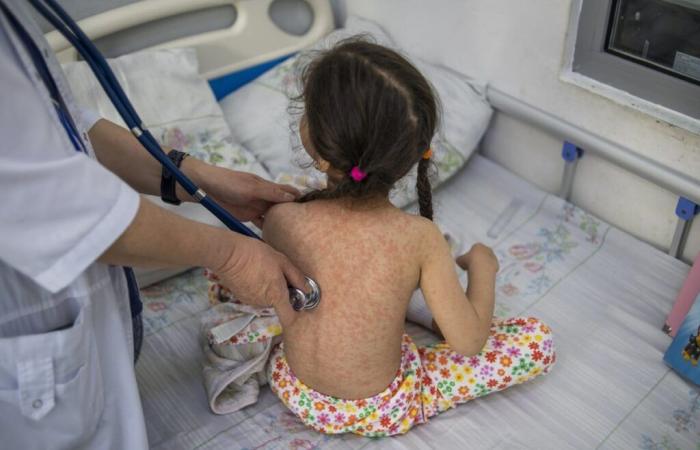 Measles cases are on the rise worldwide, with 10.3 million people infected in 2023