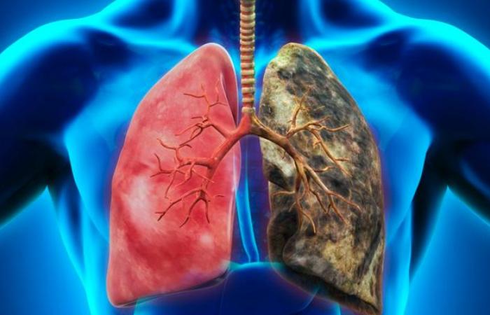 Lung cancer remains an urgent global challenge in the Middle East and Africa (LAA)