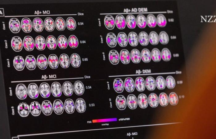 Alzheimer’s drug Leqembi will soon be available in the EU