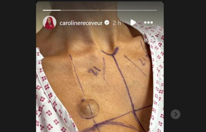 Caroline Receveur “lighter than ever at 37”: breast reduction and no more implants, she shares photos of her freedom