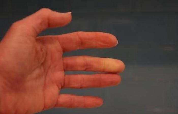 Do you have cold hands? This 1-minute test will tell you if you have Raynaud’s syndrome