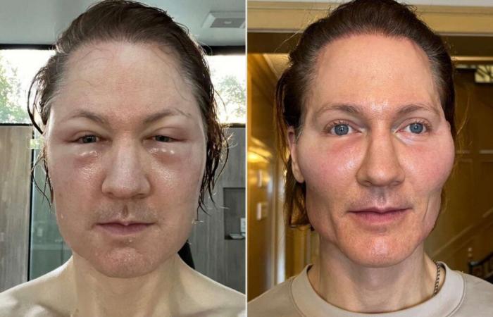 ‘Project Baby Face’ Fat Injections Cause Entrepreneur’s Face to ‘Blow Up’