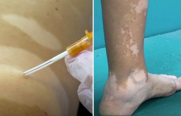 Health: a remedy against Vitiligo tested in Reunion