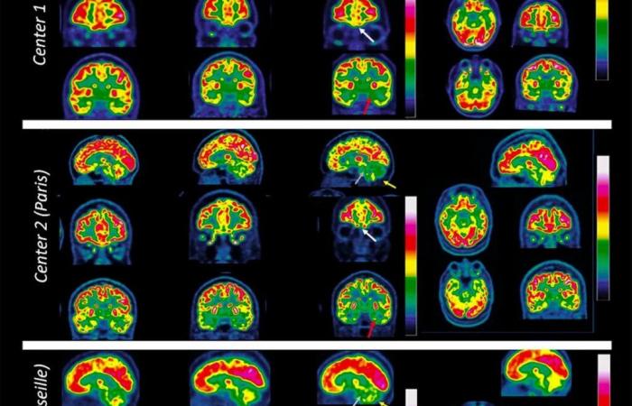 What we know about the impact of Covid on your brain