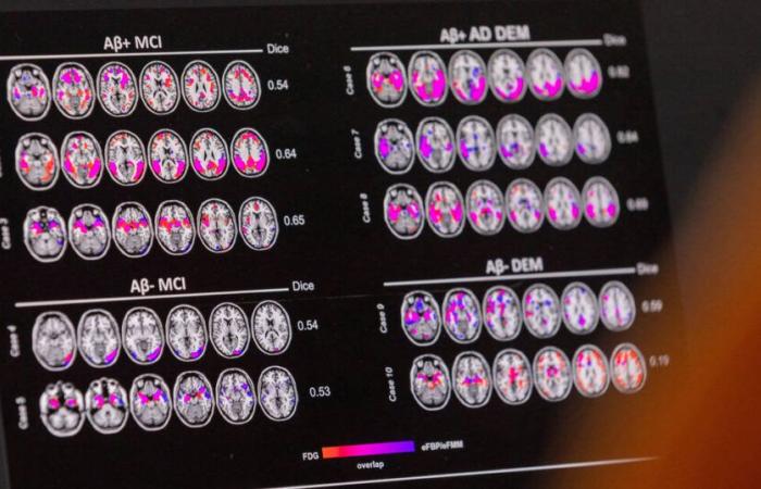 What if the High Authority for Health demonstrated independence on anti-Alzheimer drugs? – Liberation