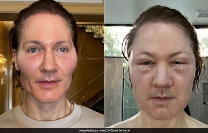 Tech Millionaire Bryan Johnson’s Face ‘Blows Up’ After Anti-Ageing Experiment Goes Wrong