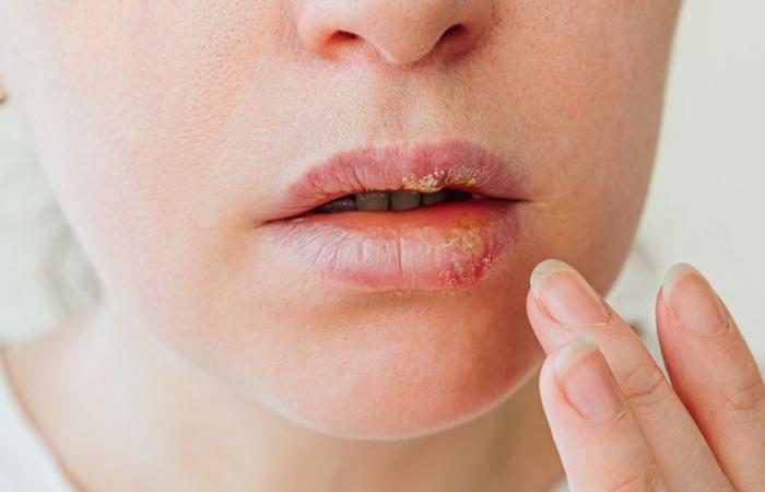 Herpes: 7 things to know about a common virus