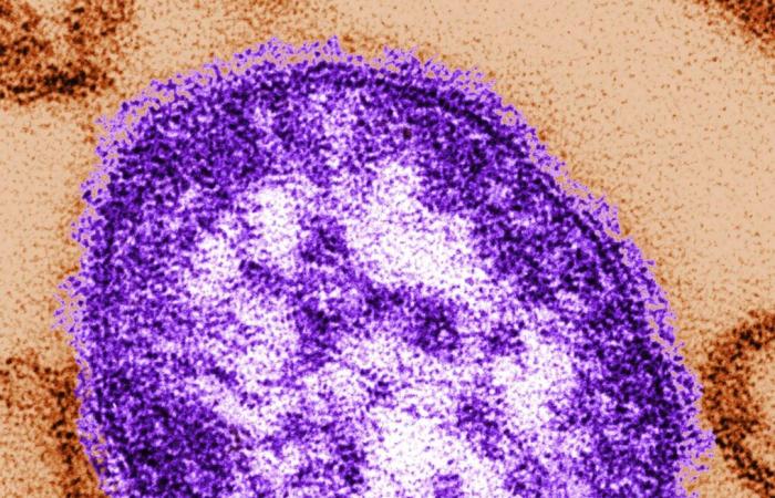 The death toll from the measles outbreak in NB reaches 44 cases, mainly young people