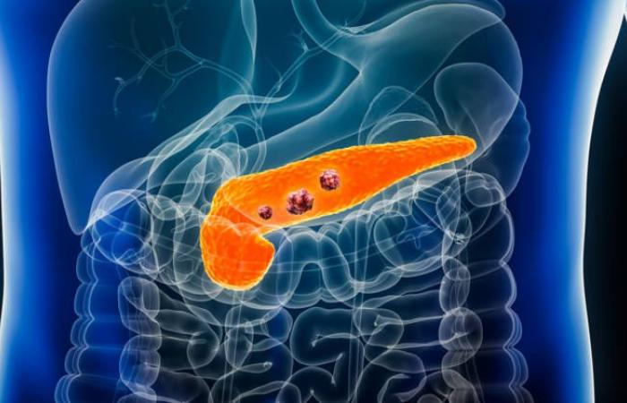 The scourge of pancreatic cancer