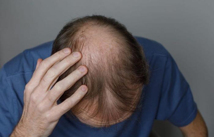 This Male Hair Loss Treatment Works Better Than Others