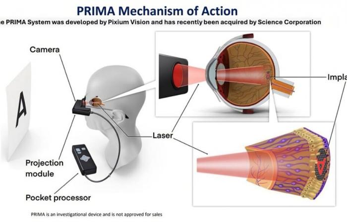 This device succeeds in restoring sight to blind people ????️