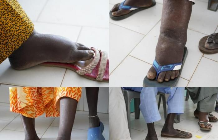 NEGLECTED TROPICAL DISEASES, A PAINFUL REALITY IN KHOMBOLE