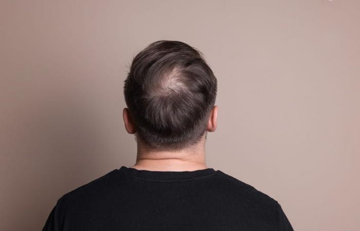 This Male Hair Loss Treatment Works Better Than Others