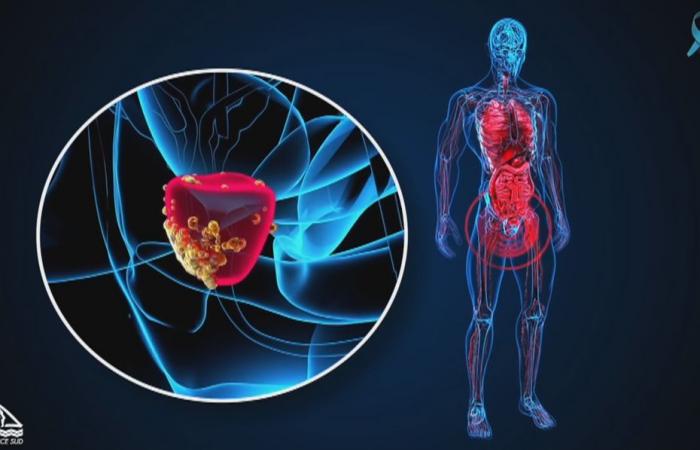 Six things to know about prostate cancer in New Caledonia