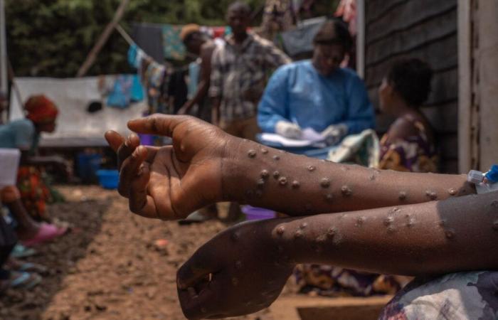 Mpox in the DRC: WHO maintains its highest level of alert | APAnews