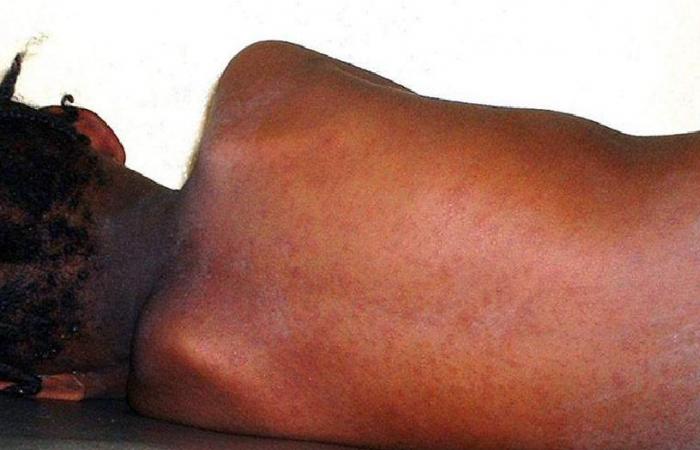 Senegal has so far recorded 449 cases of measles in 2024