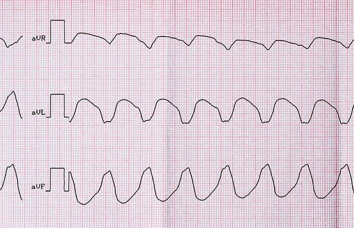 first-line ablation, a defensible option