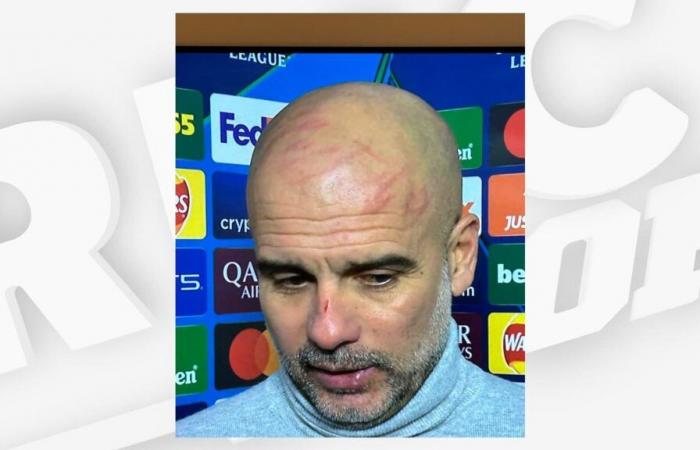 the scary scratches on Guardiola's face after Manchester City's draw against Feyenoord