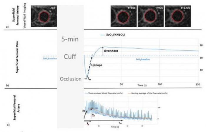 MRI identifies vascular changes caused by vaping