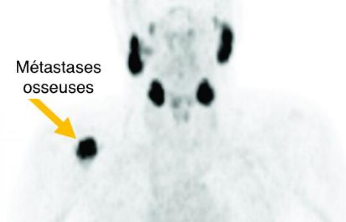 Lu-PSMA, the radiopharmaceutical that attacks prostate cancer