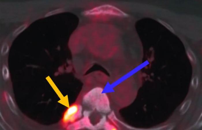 Lu-PSMA, the radiopharmaceutical that attacks prostate cancer