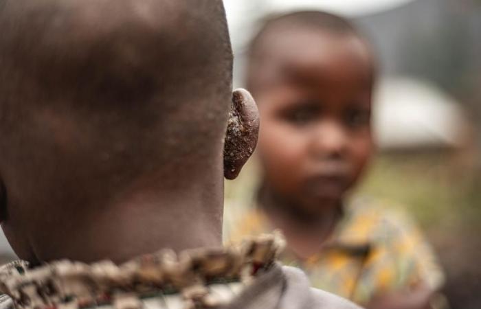 (Multimedia) Nearly 60,000 cases of mpox in Africa, 20 countries affected (Africa CDC) – Xinhua