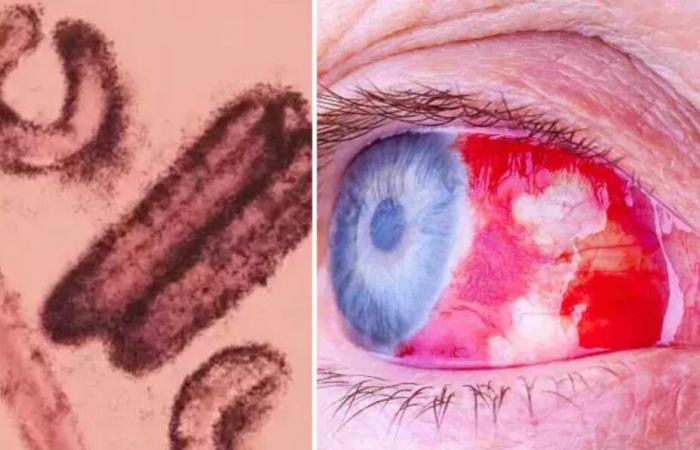 Bleeding Eye Virus Causes Global Panic as Deadly Marburg Spreads to 17 Nations