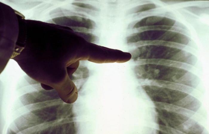 Tangier: MPs warn of the worrying increase in the number of tuberculosis cases