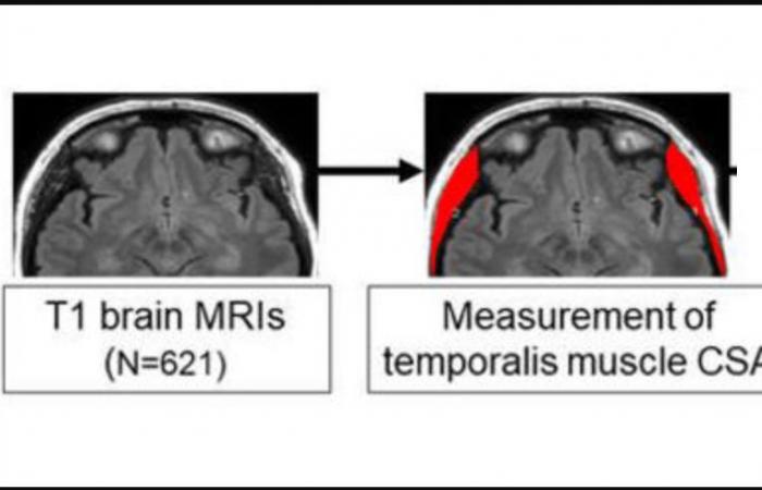 Temporal muscle loss could be a warning sign of Alzheimer’s