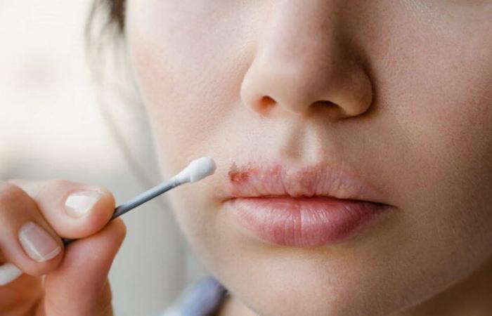 Dermatology. Herpes: seven things to know about this common virus