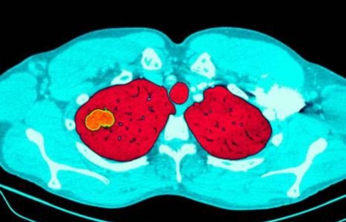 Lung cancer screening: a program is deemed cost-effective in Australia, deployment planned for summer 2025