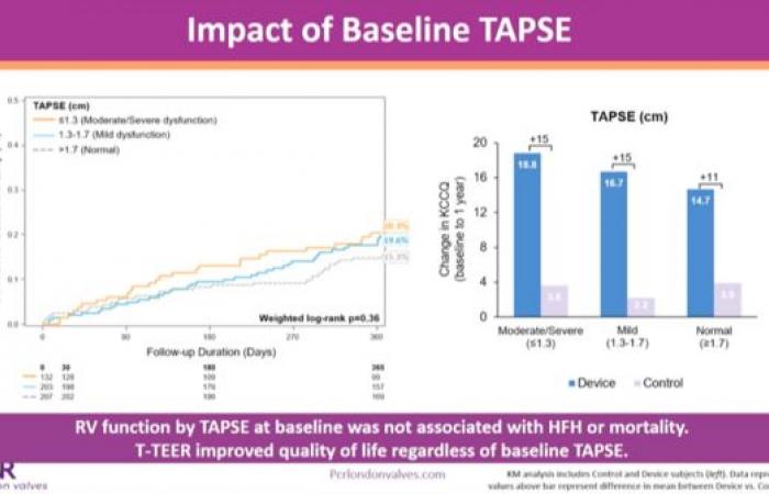 Reshaping of the right heart after tricuspid repair by TriClip