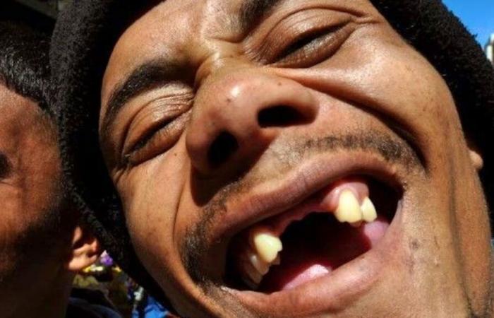 Researchers working on drug to regrow teeth