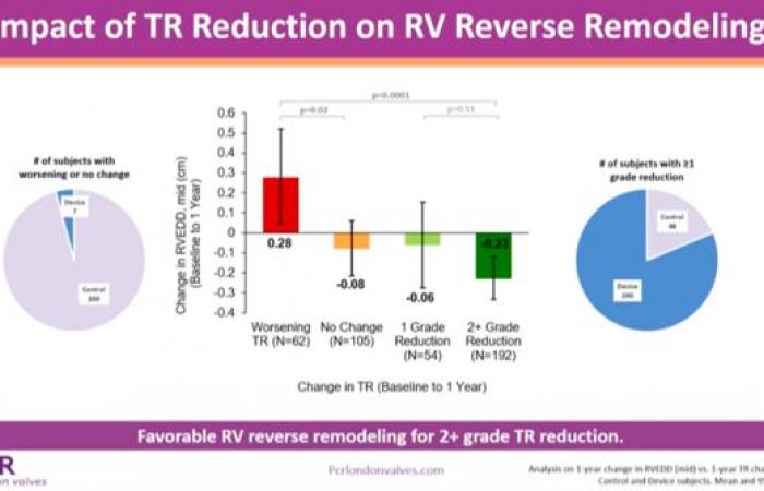 Reshaping of the right heart after tricuspid repair by TriClip