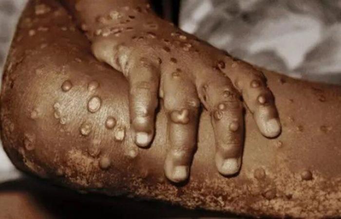 Another confirmed case of Mpox in the country, this time in Uíge