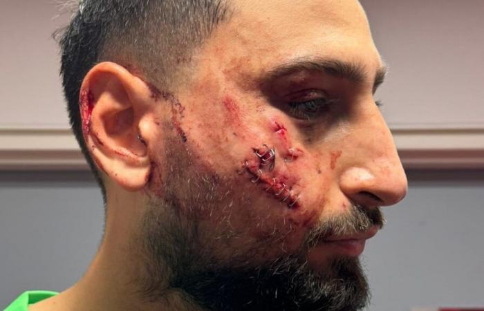 the images of the impressive injuries of Donnarumma, who had ten staples placed on his face