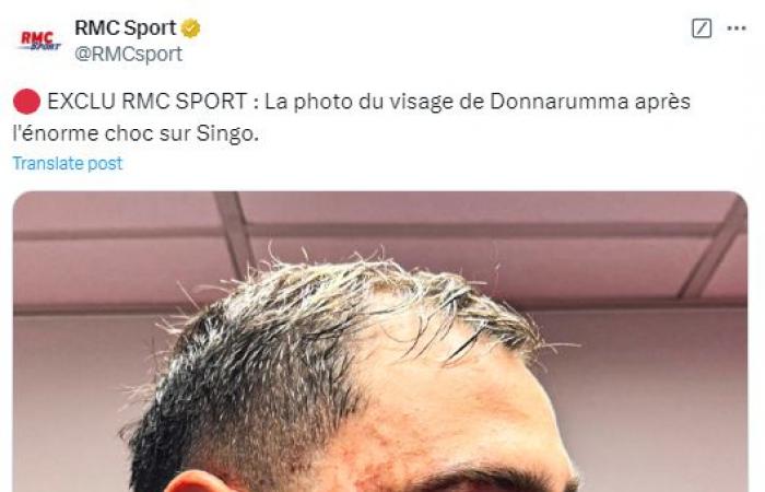 Gigi Donnarumma’s face bleeds with nasty gash before being stapled together from horror studs-up challenge