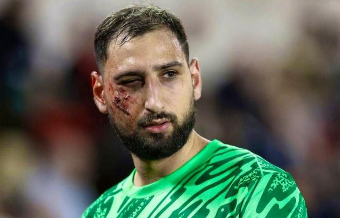 The PSG goalkeeper: Horrible injury for Donnarumma, who gets studs in the face