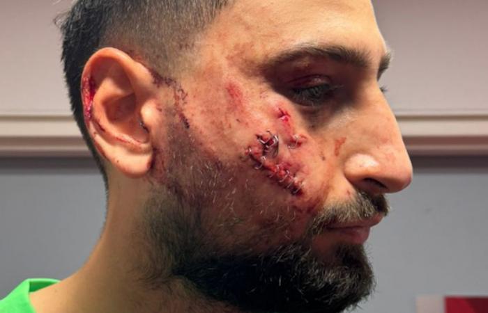 “Facial trauma”, “multiple wounds”, treated with staples: the impressive injury of the PSG goalkeeper who appeared with a swollen face after a spike with crampons