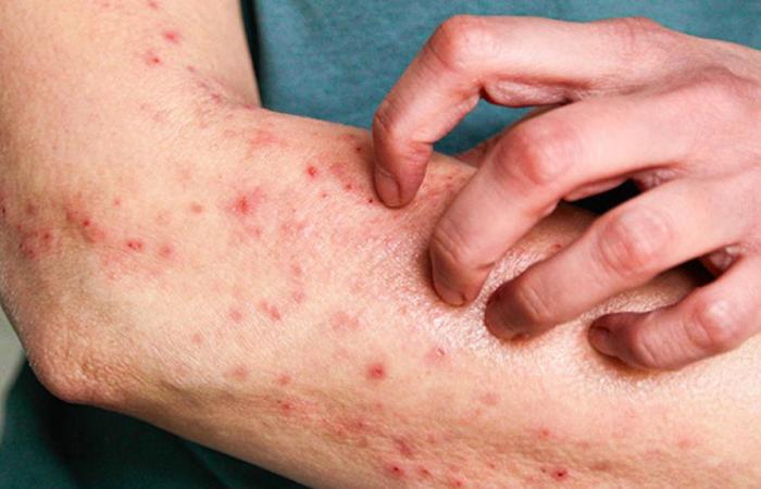 CHUV: Breakthrough in the treatment of skin diseases