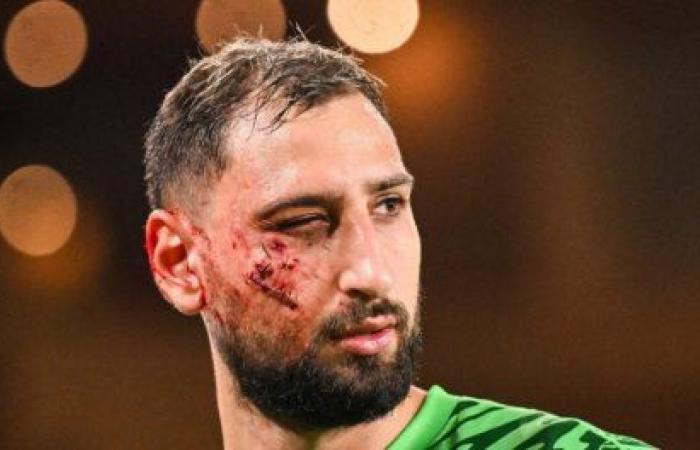 Facial trauma with multiple wounds for Donnarumma, package in Lens